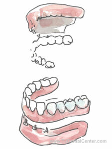 All on 4 Dental Implants