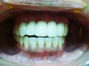 Dental Implants-After