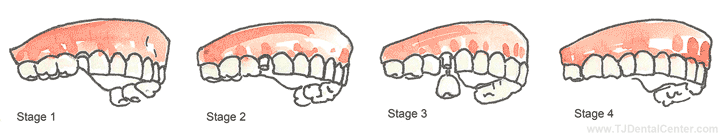 Single Dental Implants