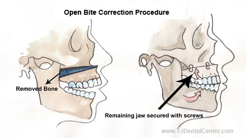 Open Bite Correction Jaw Surgery - Tijuana,Mexico