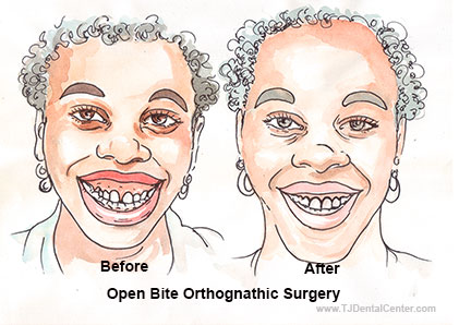 Orthognathic Surgery in Tijuana Mexico for Open Bite Correction