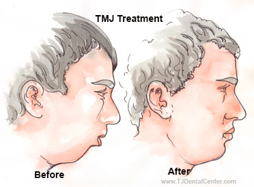 TMJ Treatment - Before-and-After