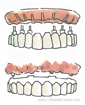 All-on-6 Dental Implants
