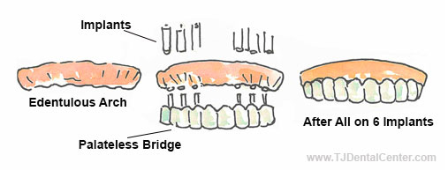 All-on-6 Implants in Tijuana - MX