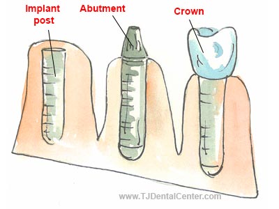 Dental Implant - Tijuana - Mexico