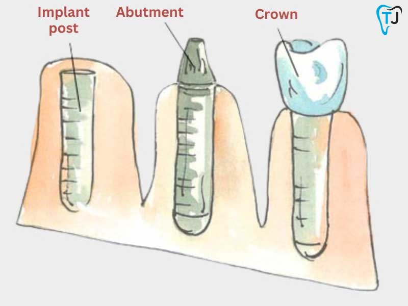 Structure of a Dental Implants in Tijuana