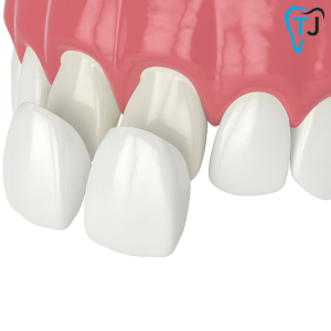 Composite Veneers