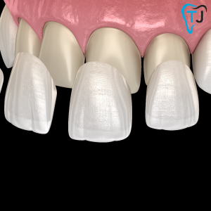 Zirconia Veneers | Dental Veneers in Tijuana 