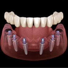 3 on 8- All on 6 Dental Implants in Tijuana