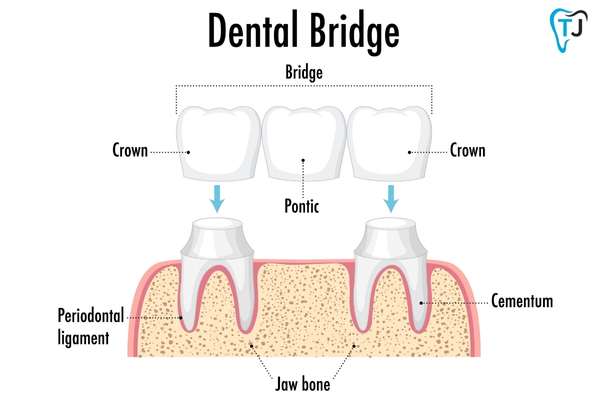 Dental Bridge