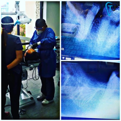 Dental Extraction in Tijuana, Mexico: Before & After