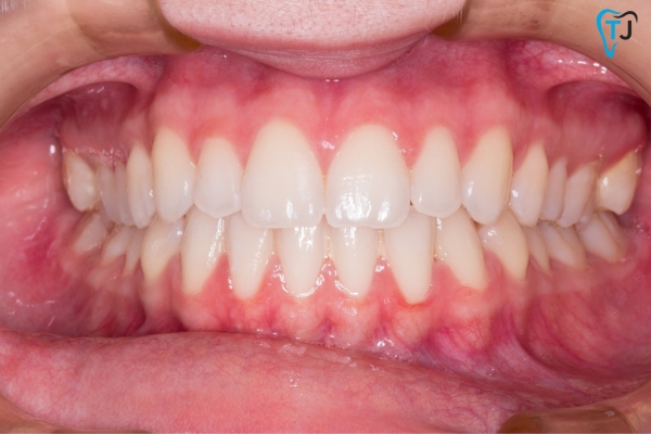 Healthy Gums with Scaling and Root Planing in Tijuana, Mexico