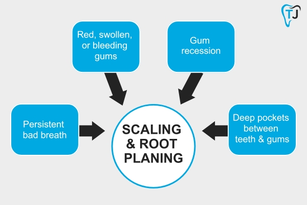 When Do You Need Professional Teeth Cleaning?