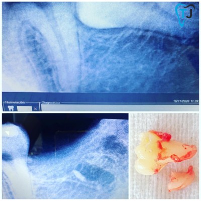 Dental Extraction in Tijuana, Mexico: Before & After