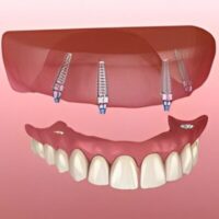 all on 4- All on 6 Dental Implants in Tijuana