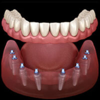 3 on 6- All on 6 Dental Implants in Tijuana