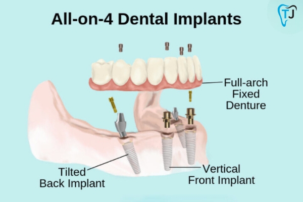 All on 4 dental implants in Tijuana