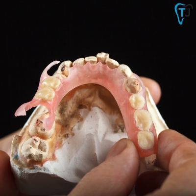 Partial Dentures