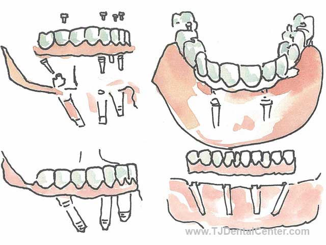 All-on-4 dental implants in Tijuana, Mexico